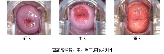 成都专业治疗宫颈糜烂的医院